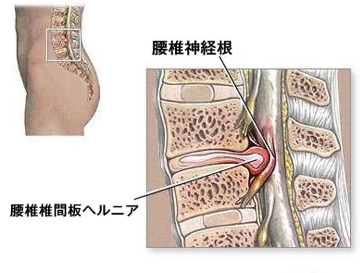 椎間板ヘルニアとは? 手術しなくてもヘルニアでも全く心配しなくていいこんな理由!